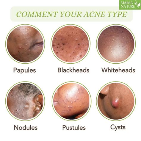 Acne treatment requires .